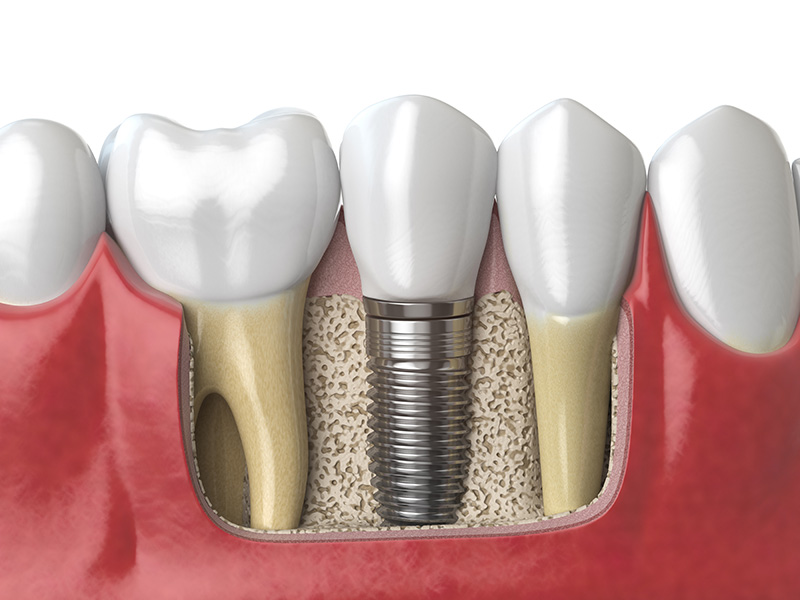 Dental Implant Cost