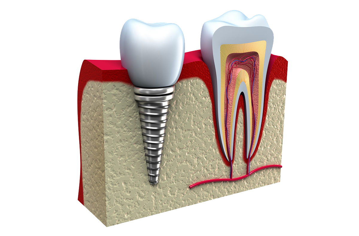 Dental Implants